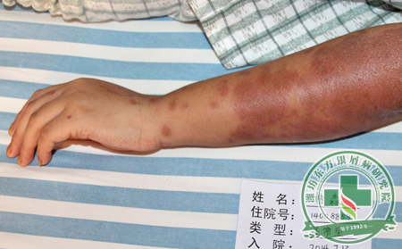 济南银屑病医院答患者可以吃鸡毛菜吗