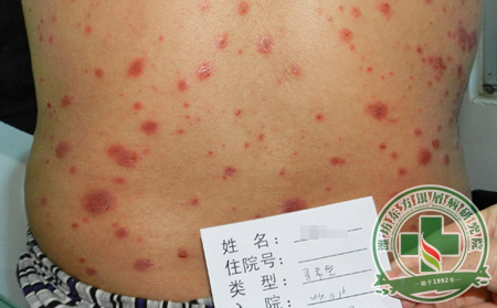 敷面膜对面部银屑病患者有影响吗？