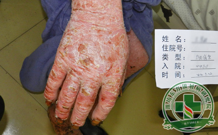 银屑病护理