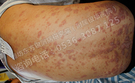 背部牛皮癣平时要怎么预防