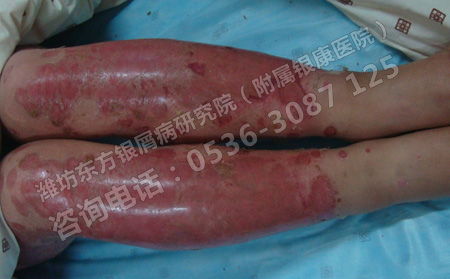 容易诱发牛皮癣的一些生活习惯