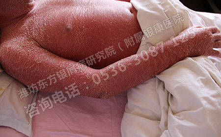 银屑病加重了跟什么有关系呢
