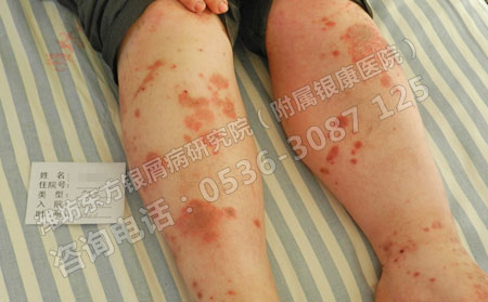 春季济南牛皮癣治疗不见到效果跟什么有关