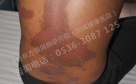 银屑病怎么护理对病情可以