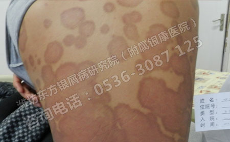 牛皮癣该怎么护理效果可以呢