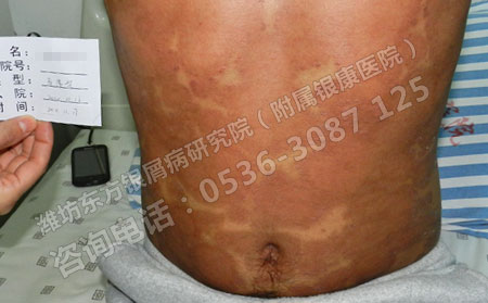 牛皮癣怎么护理更可以的治可以呢