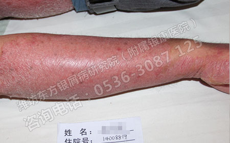 红皮型牛皮癣患者在生活中要注意什么