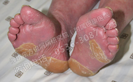 牛皮癣危害大怎么办可以呢