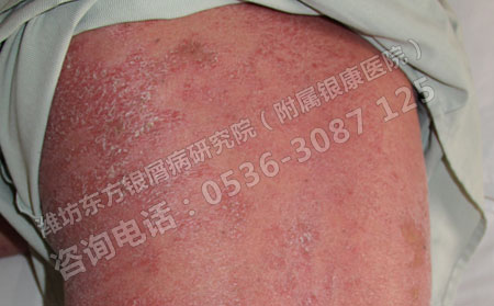 银屑病患者全身红皮病情严重还有救吗是否需要放弃
