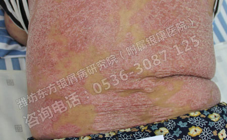 牛皮癣怎么护理让治疗事半功倍