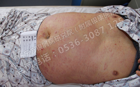 患上寻常型银屑病怎么进行治疗可以呢