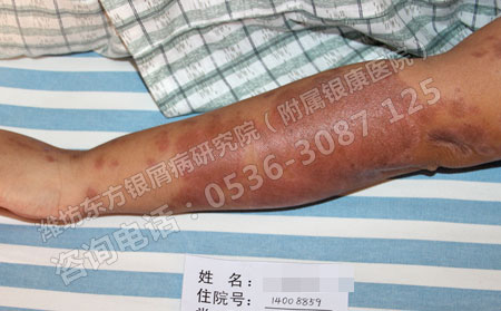牛皮癣临床可以了可以避免复发吗有什么可以方法