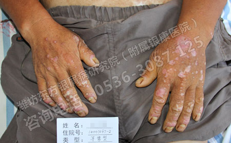 夏季预防银屑病进行中患者您准备可以了吗