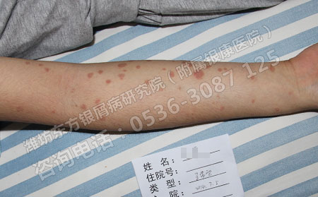 天气逐渐炎热牛皮癣防工作治刻不容缓