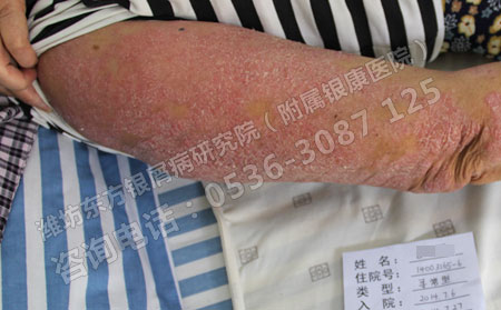 天气炎热蚊虫多牛皮癣患者怎么做皮肤伤害小