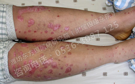 牛皮癣一再反复愁人有什么有效措施可以改善