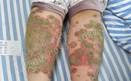 不遵守医嘱牛皮癣患者可能会产生哪些可怕后果
