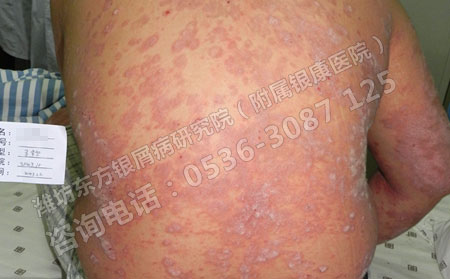 银屑病治可以一段时间后再次出现怎么回事