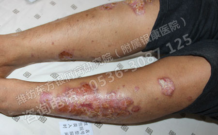 济南医生解析轻微银屑病短期内恶变的几大主因