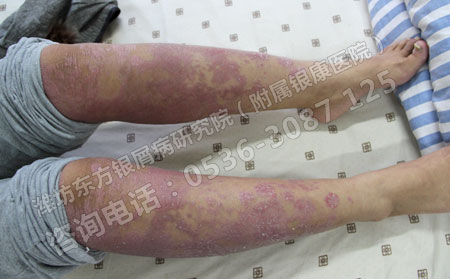 青春期被牛皮癣盯上该怎么进行下一步的控制