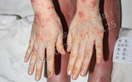 夏季到来牛皮癣症状变浅变淡是否是自己可以了呢