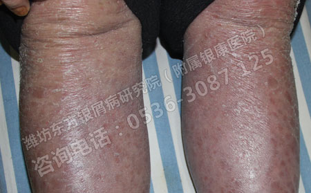  如何保护可以皮肤防止银屑病的发生