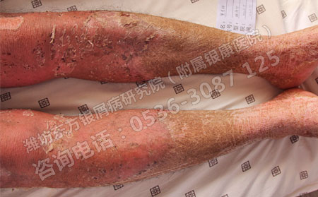 生活中预防银屑病出现的四大绝招
