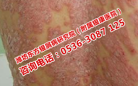 牛皮癣再次出现的原因有哪些