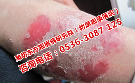 女孩牛皮癣短期内消失