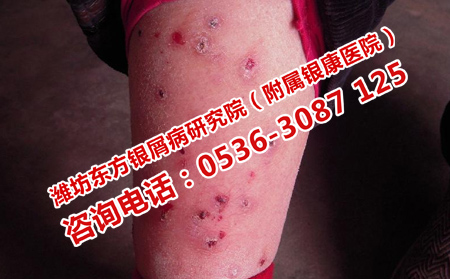 腿部牛皮癣怎么消退