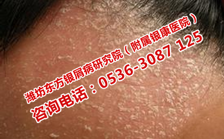 怎么减少牛皮癣蔓延到身上