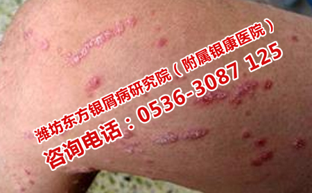 为何您的牛皮癣多次出现