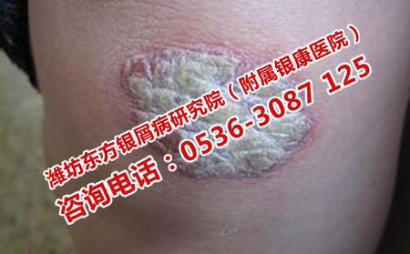 小孩牛皮癣吃不下饭怎么办
