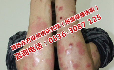 牛皮癣护理注意什么