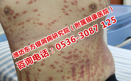 牛皮癣预防加重的方法