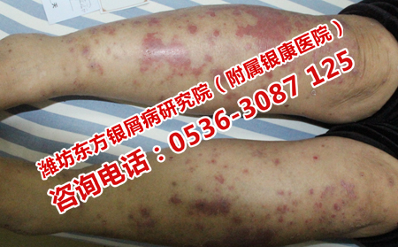 牛皮癣危害健康严重吗