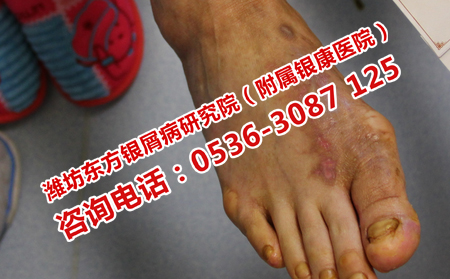 牛皮癣不恢复的原因