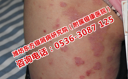牛皮癣病情怎么护理可以呢