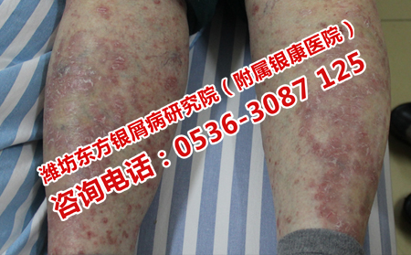 牛皮癣患者怎么远离健康隐患