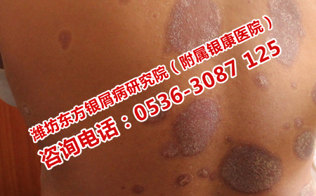 牛皮癣怎么细节护理