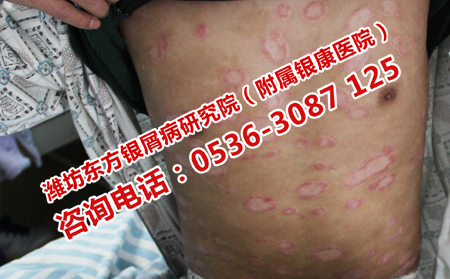 牛皮癣症状有必要治吗