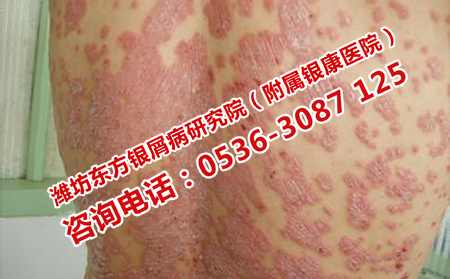 牛皮癣的临床护理