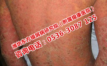 儿童牛皮癣怎样预防
