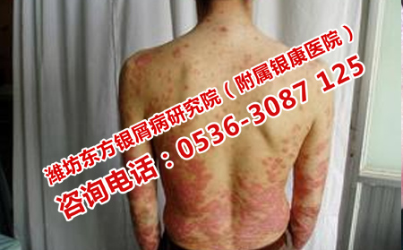 牛皮癣为什么断断续续的发病
