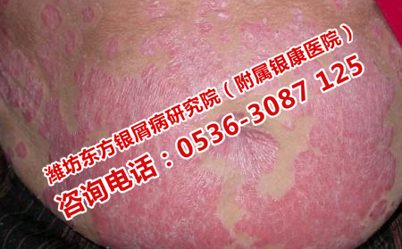 牛皮癣是什么因素导致的