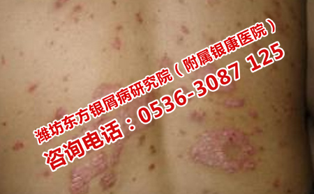 牛皮癣恢复不全面是什么原因