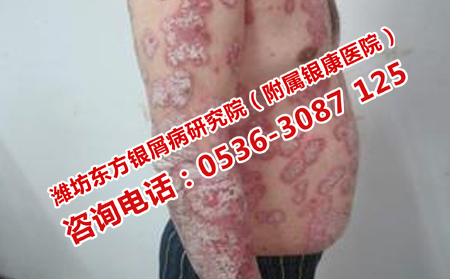 牛皮癣复发之前有什么症状