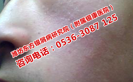 治疗寻常型银屑病有效的方法