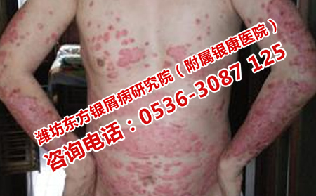 牛皮癣患者如何护理