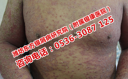 预防银屑病复发加重的方法